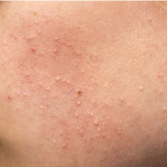 Acne cosmetica