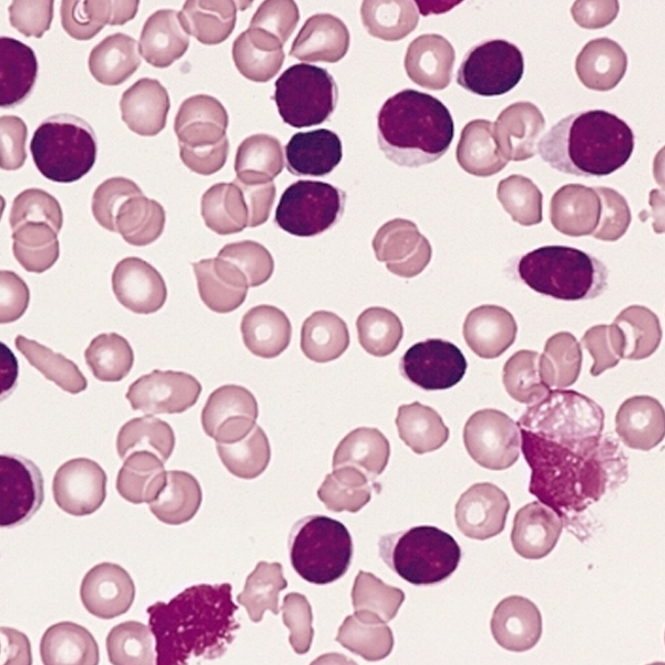 B-cell chronic lymphocytic leukemia logo