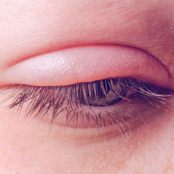 Eyelid