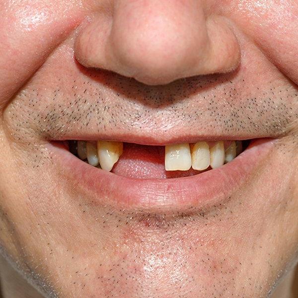 Tooth loss logo