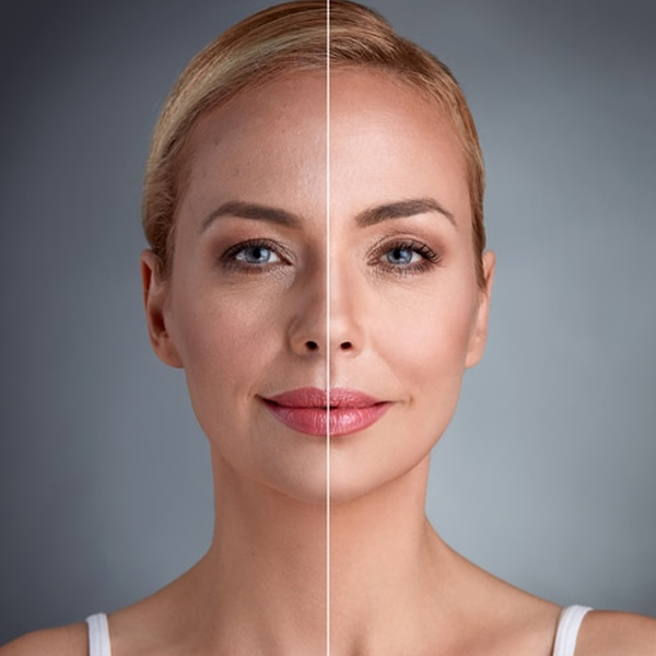 Ultherapy