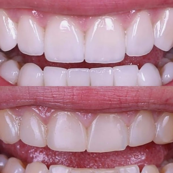 Veneer (dentistry) logo