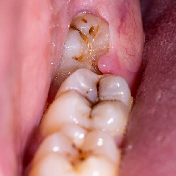Wisdom tooth logo