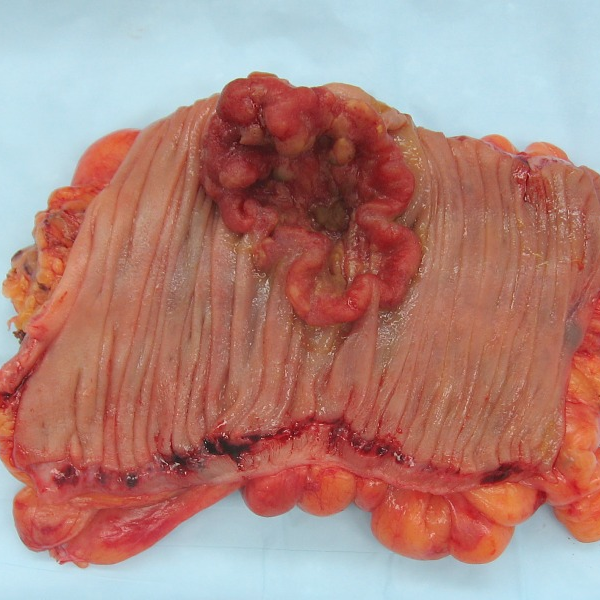 Neoplasm logo