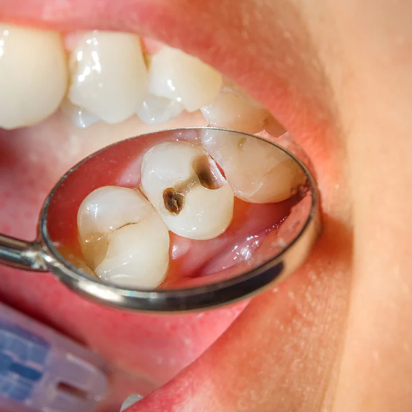 Dental caries