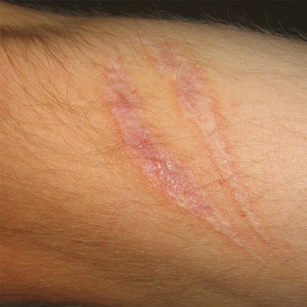 Scar