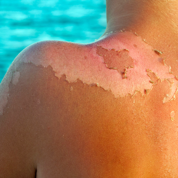 Sunburn