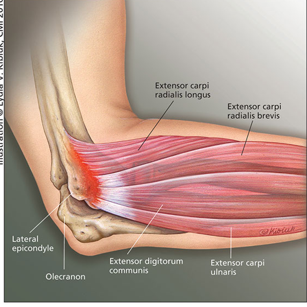 Tennis elbow