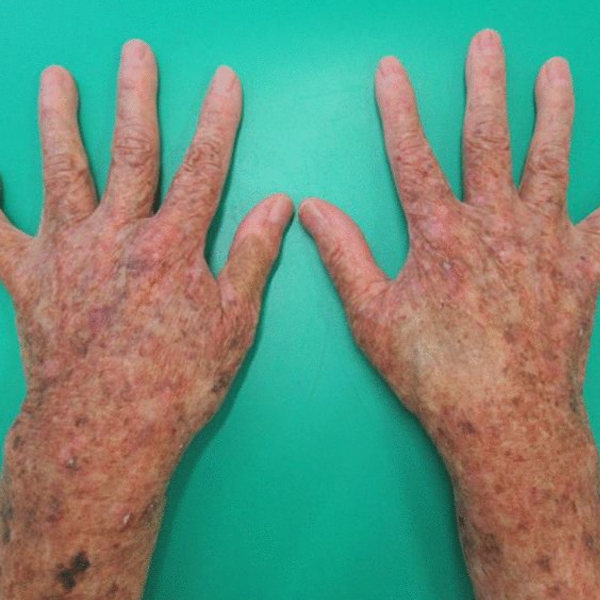 Xeroderma logo