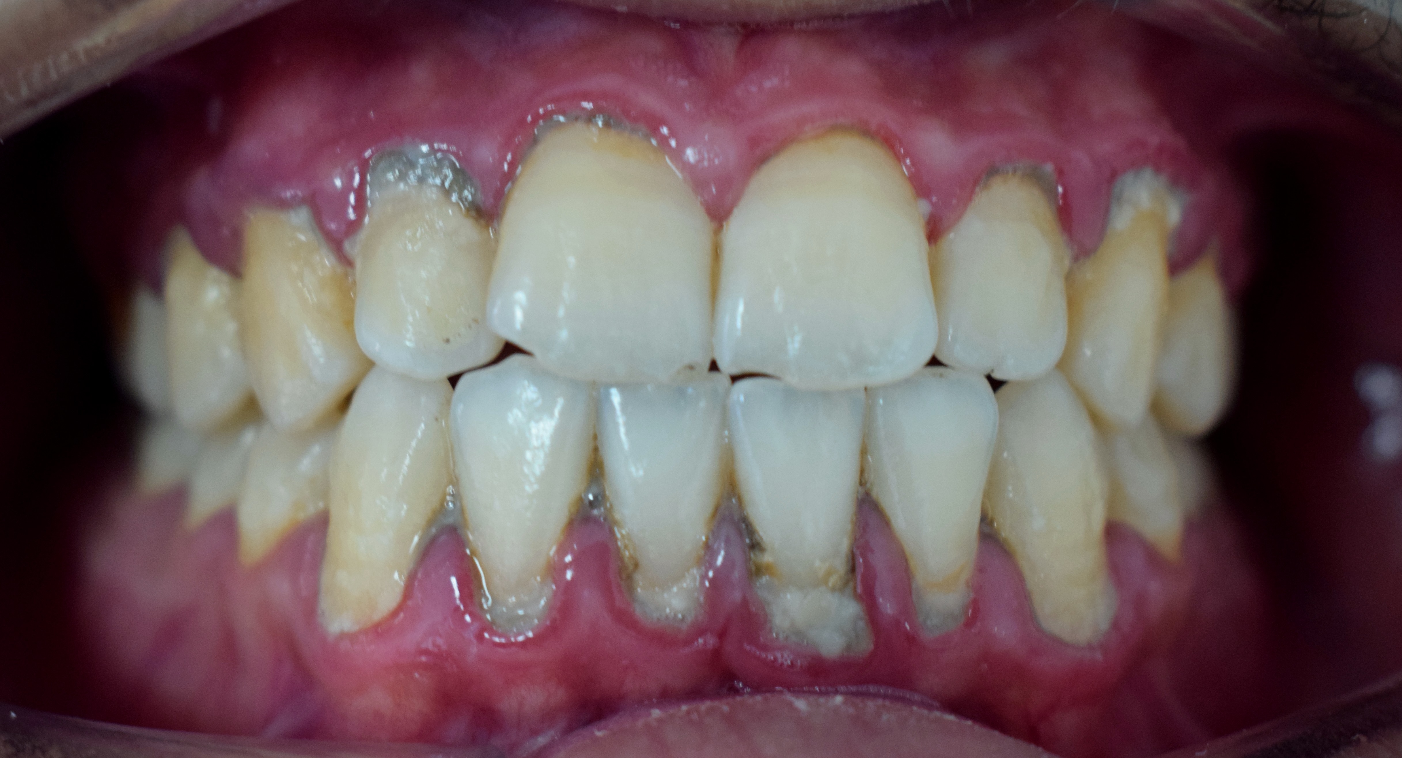 Dental plaque