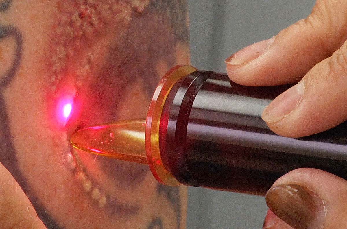 Tattoo removal logo