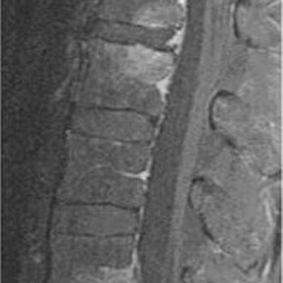 Spondylitis logo